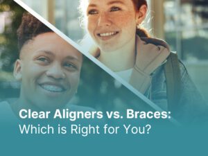 clear aligners vs braces
