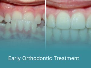 Early Orthodontic Treatment