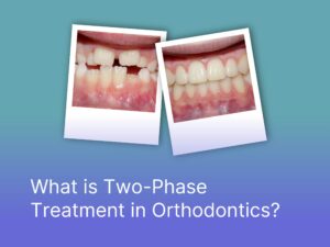 What is Two-Phase Treatment in Orthodontics?